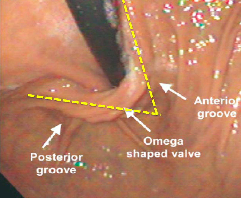 Fundoplicatura