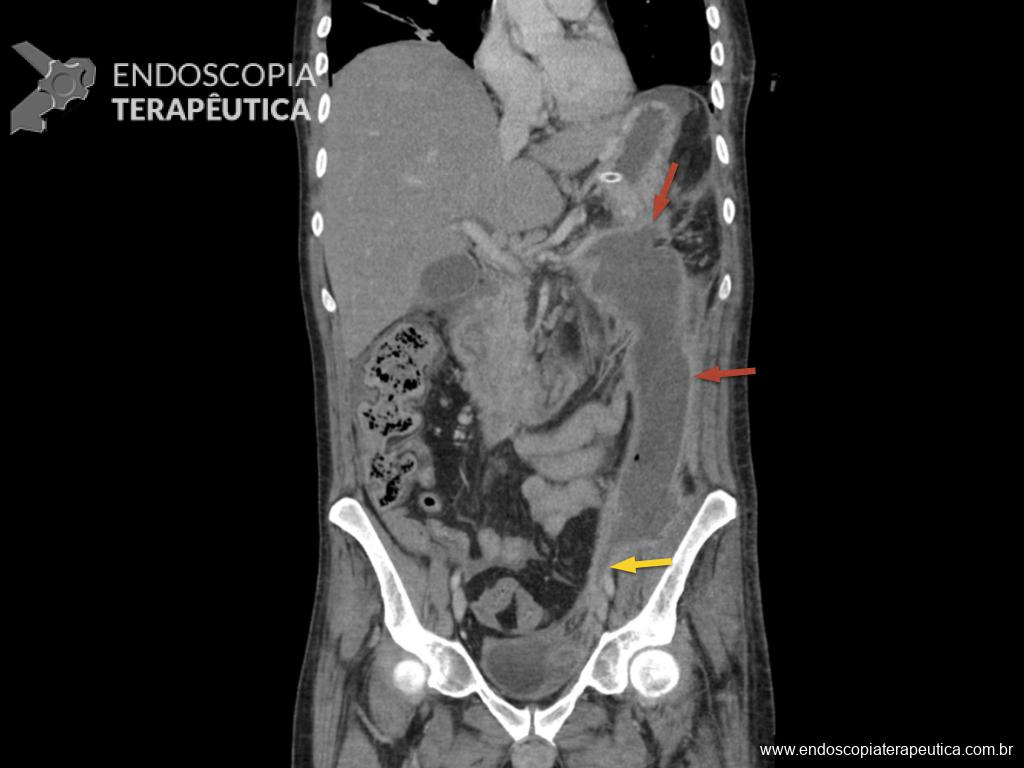 Coleção necrótica organizada massiva estendendo-se através do espaço retroperitonial (setas vermelhas) até a região inguinal esquerda (seta amarela).