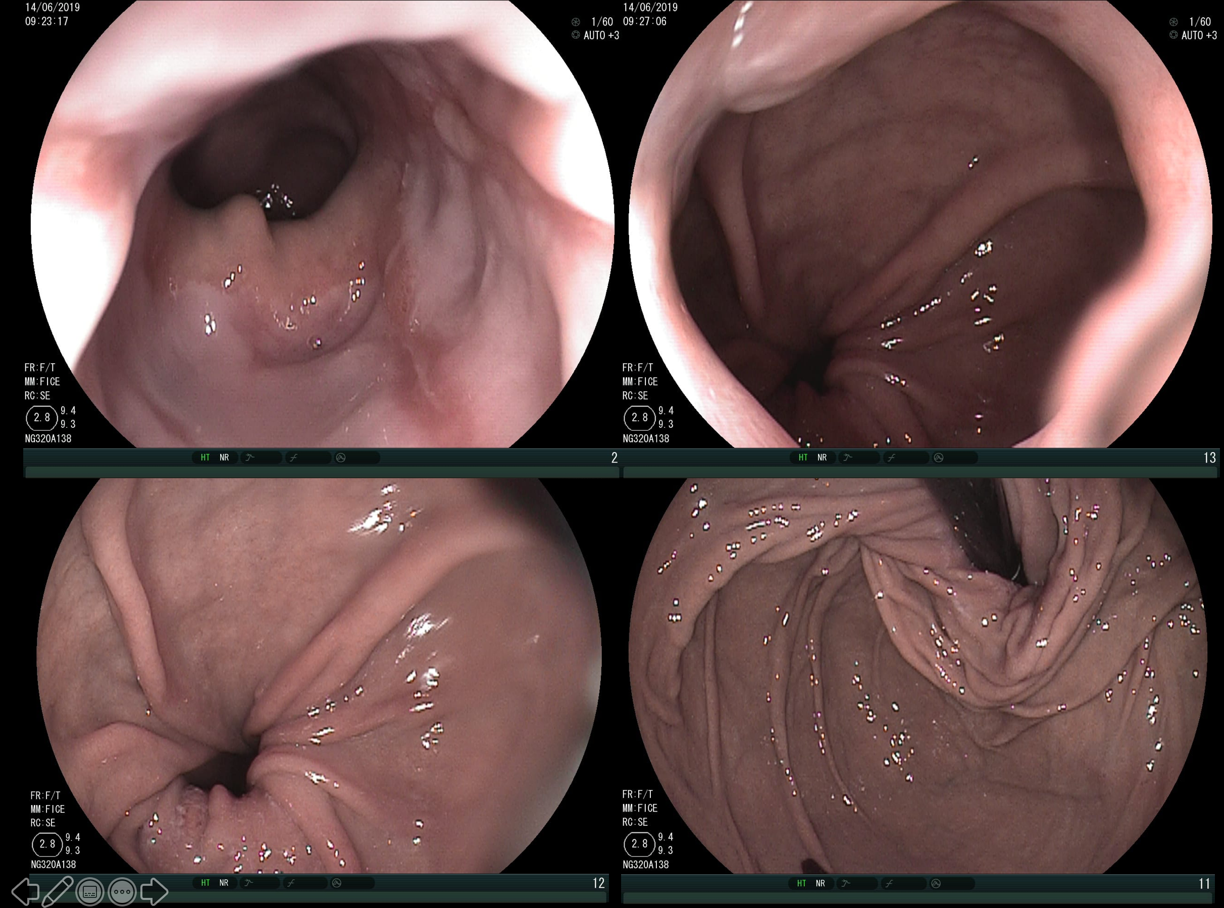 Fundoplicatura deslizada