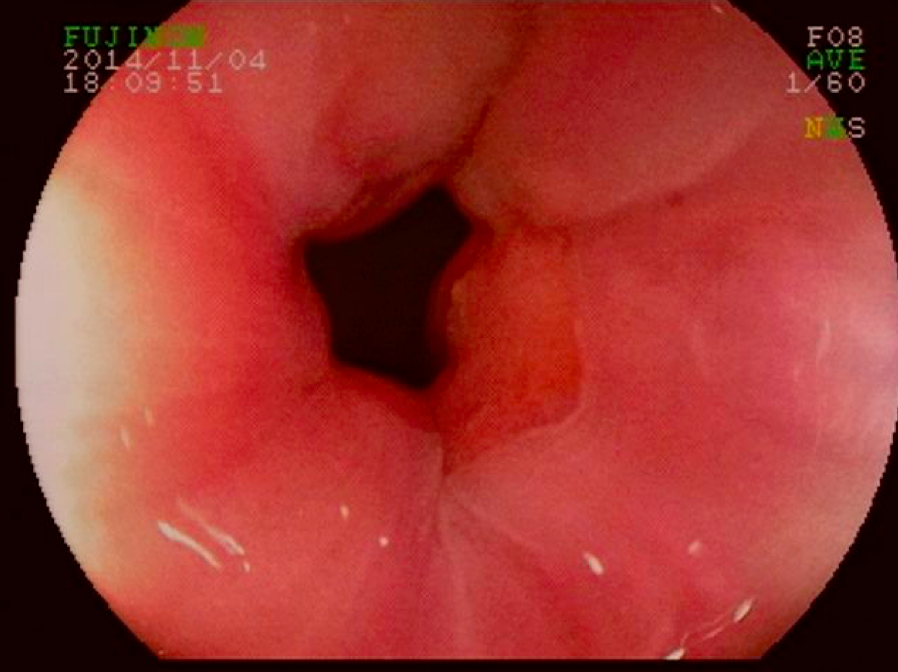 À retrovisão (fundoplicatura Toupet-Lind – 270°)