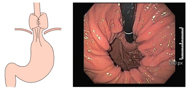 Fundoplicatura migrada