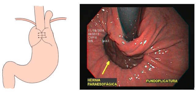 Fundoplicatura com presença de hérnia paraesofágica