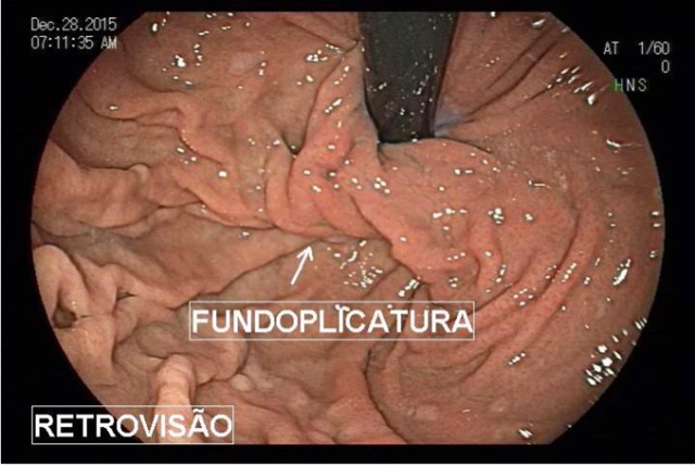 Fundoplicatura Desgarrada